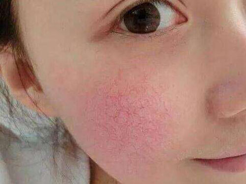 为什么脸上有红血???
