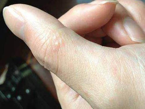 被热水烫伤起水泡怎么处理