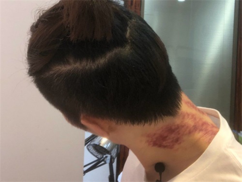 女人颈部刮痧的好???