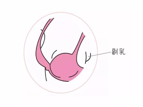 什么是副乳