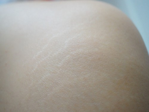 大腿的膨胀纹怎么消除
