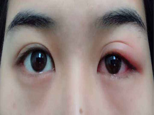 眼睑炎的症状、