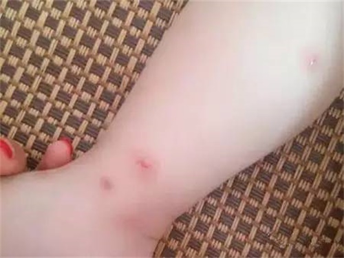 长水痘可以洗澡吗