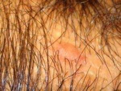 腿上毛囊炎治疗方法
