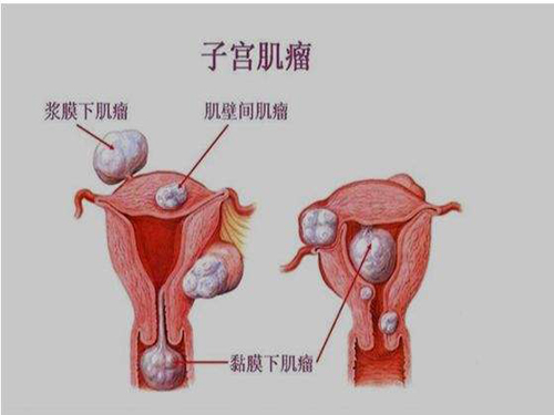 子宫肌瘤吃什么能消除