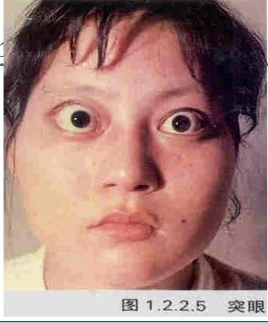 瘿肿